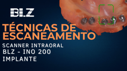 Scanner Intraoral BLZ INO200: Escaneamento de Prótese Sobre Implante - Técnicas de Escaneamento